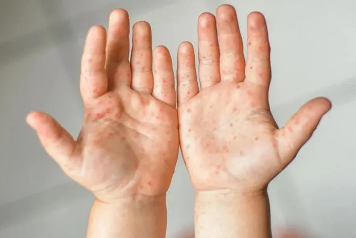 Jak długo trwa bostonka u dzieci i co warto wiedzieć?