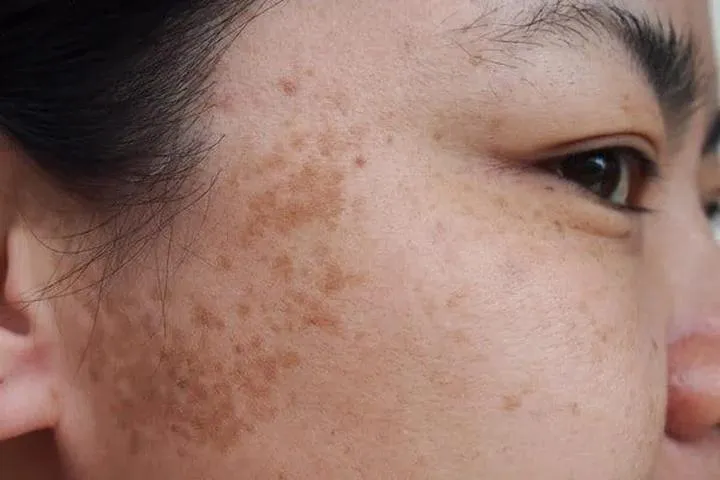 Jak skutecznie radzić sobie z plamami na twarzy po porodzie?