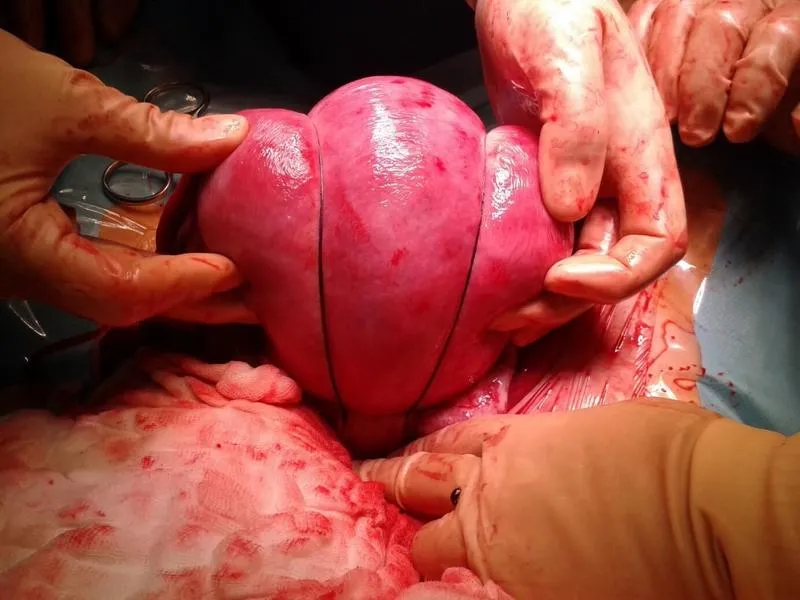 Karmienie piersią a krwawienie