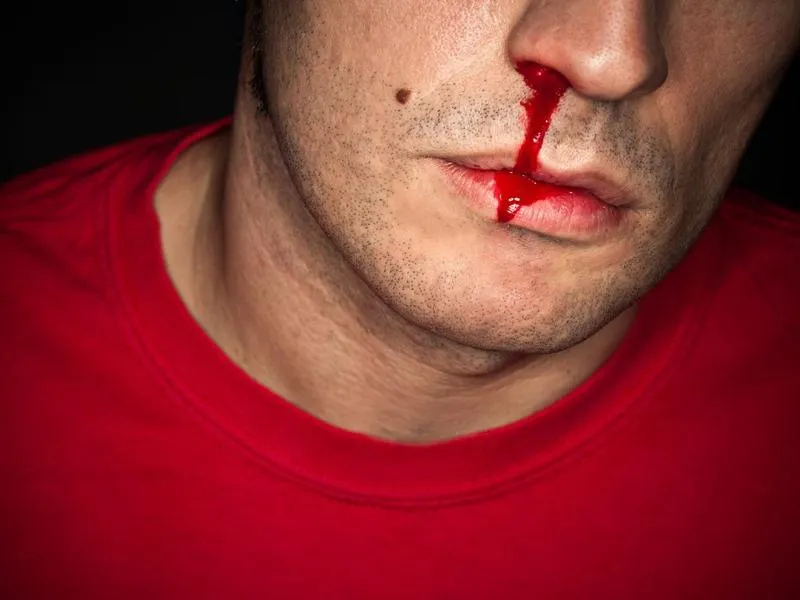 Krwawienie z nosa u dzieci