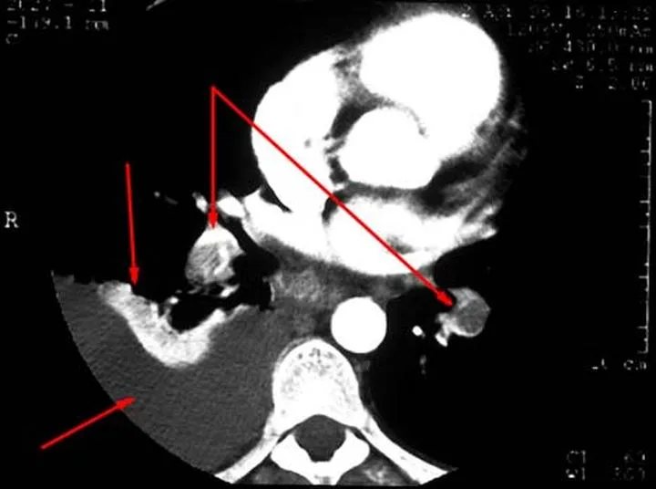 Leczenie zatorowości płucnej