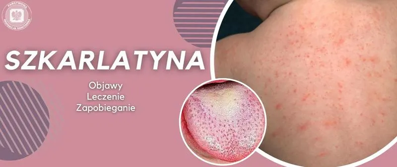 Objawy szkarlatyny