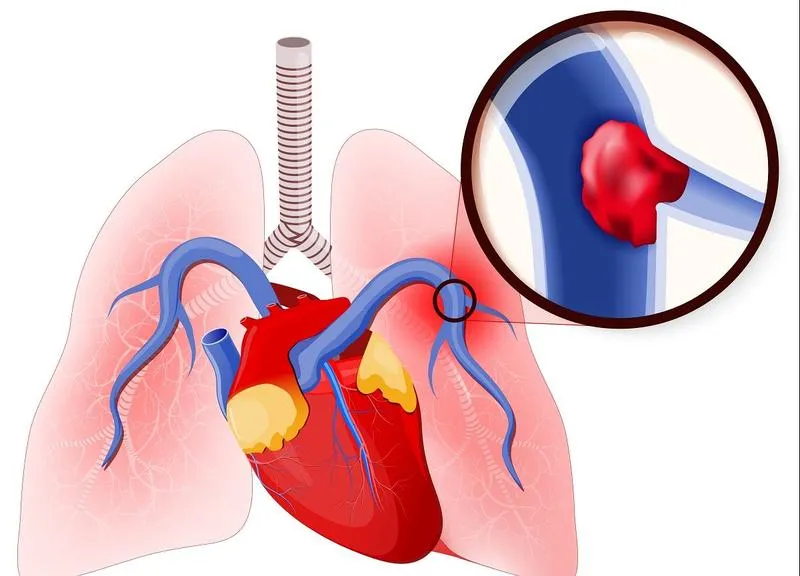 Profilaktyka zatorowości płucnej