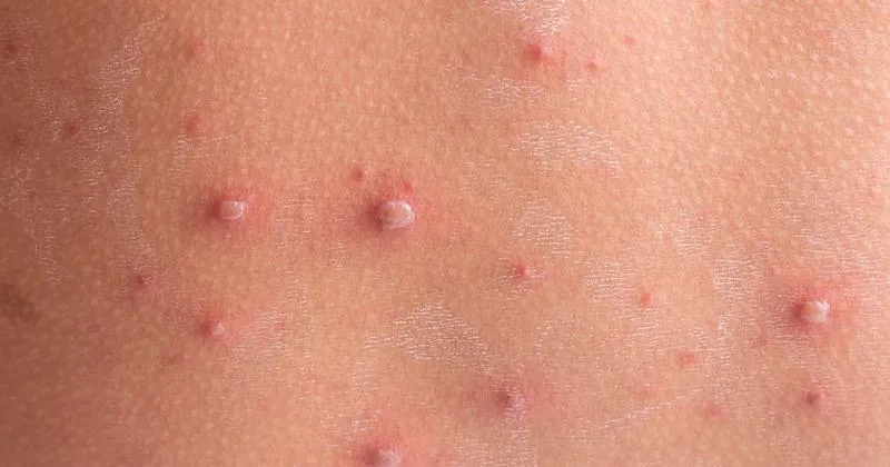 Przedszkole a ospa wietrzna