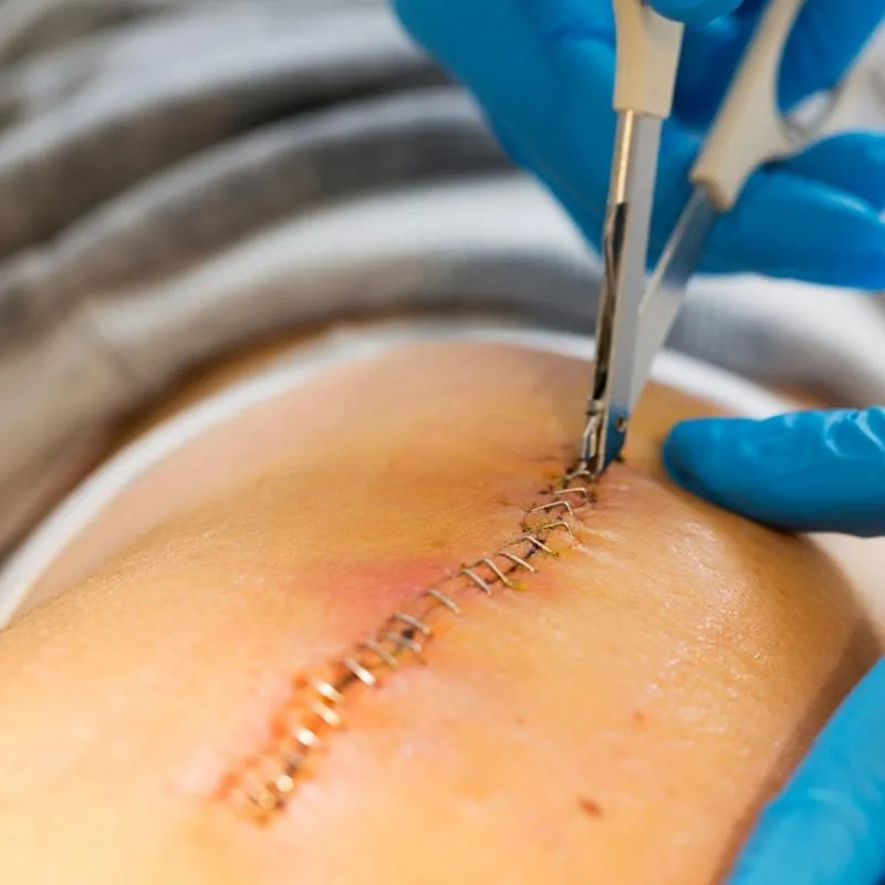 Szwy rozpuszczalne po porodzie