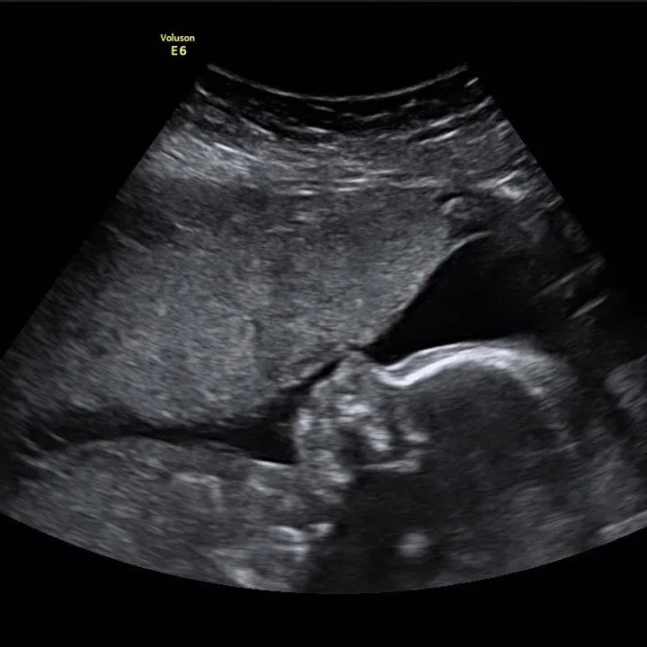 Wiarygodność USG w ciąży